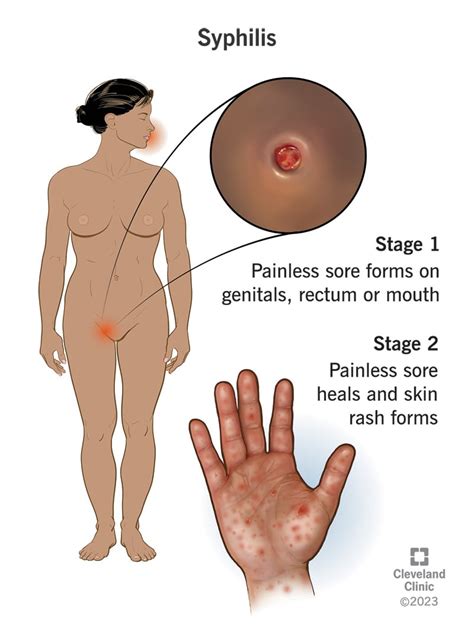 Understanding Congenital Syphilis Causes Symptoms And Treatment Ask The Nurse Expert