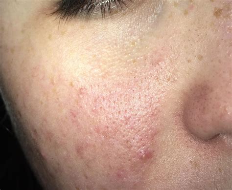 Skin Concerns Im A Teenager And Have Hormonal Acne With Really Deep