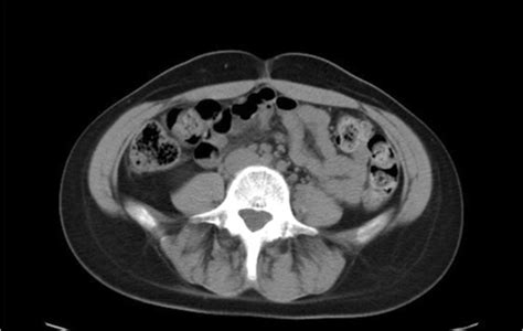 Abdominopelvic Ct Scan Where The Complete Resolution Of The Haematoma