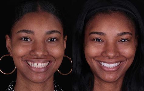 Smile Makeovers Before And After Photos In Los Angeles