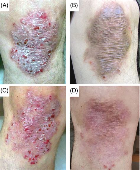 A Male Patient With Plaque Psoriasis Before Treatment With 5‐fu B
