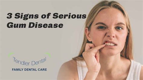 3 Signs Of Serious Gum Disease Tendler Dental