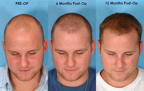 Know more about how long does it take for hair transplant grafts to regrow new hairs for the hair transplant patients. All about Hair Transplant Surgery | Men's Answer