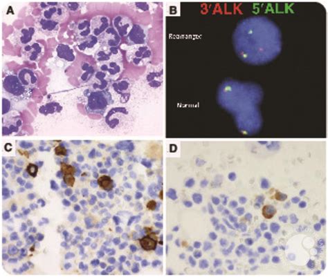Alk Positive Anaplastic Large Cell Lymphoma With Marked Leukemoid