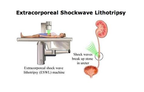 Eswl External Shockwave Lithotripsy In Bhopal Urologist Bhopal