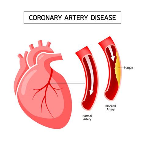 Top 60 Coronary Artery Disease Clip Art Vector Graphics