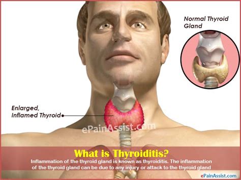 What Is Thyroiditis Causes Symptoms Treatment Diagnosis