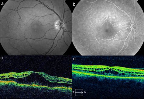 Case Cystoid Macular Edema After Treatment With Docetaxel For Download Scientific Diagram