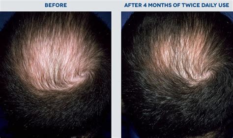 Hair loss can have many causes. ROGAINE Minoxidil Men Hair Thinning Loss REGROWTH FOAM ...