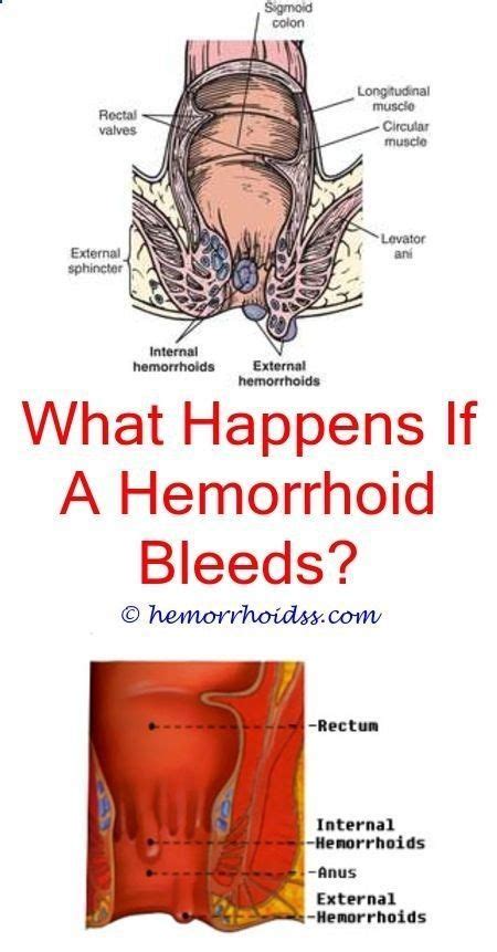 Hemorrhoids Can Be Incredibly Uneasy And Very Painful If You Have Them