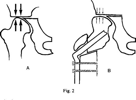 Figure 2 From Combined Intertrochanteric And Chiari Pelvic Osteotomies