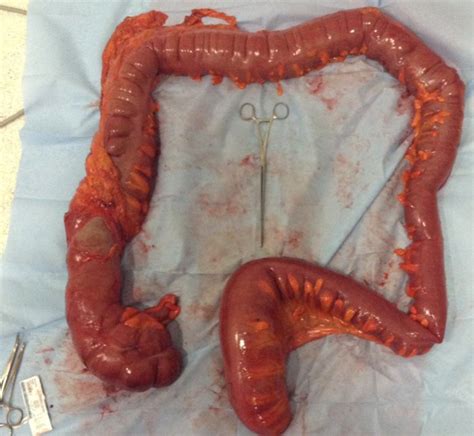 Preventing egg yolk peritonitis in chickens is a tricky thing. Peritonitis | Mexico | PDF | PPT| Case Reports | Symptoms ...