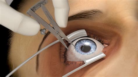 Intravitreal Injection