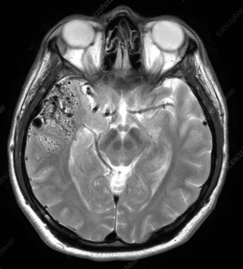 Temporal Lobe Sagittal Mri