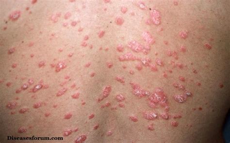 Guttate Psoriasis Treatment Pictures Photos