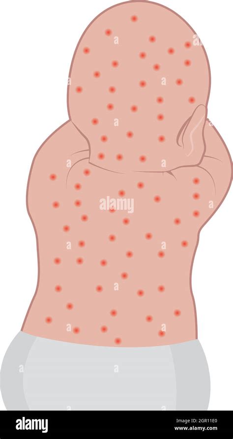 Babe Baby Skin Rash Eczema Stock Vector Images Alamy