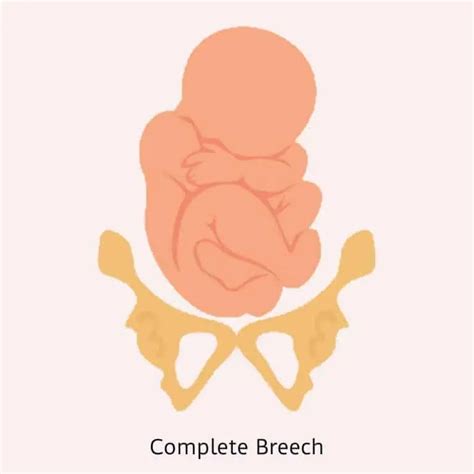 Breech Definition Types Of Breech Presentation Breech Birth Defects