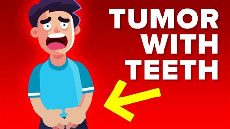 Video Infographic Man Grows Tumor With Teeth Inside Testicles Infographic Tv Number One