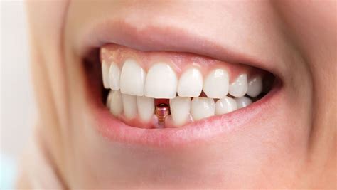 Cuándo es necesario un implante dental Actualizado