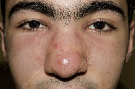 Cystic Acne Stock Image C0070704 Science Photo Library