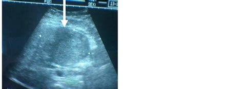 Correlation Between Abdominal Ultrasonographic Findings And Cd Cell Count In Adult Patients