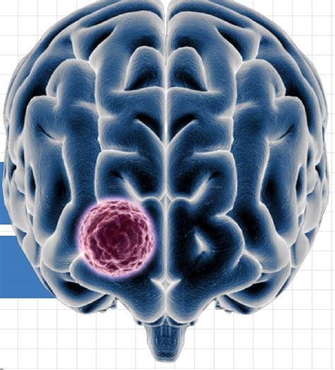 Brain Tumors Signs And Treatments Houston Neurosurgery And Spine
