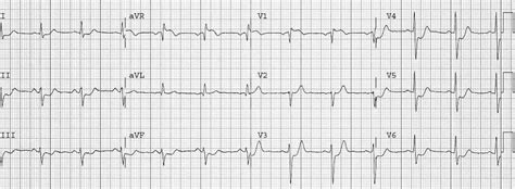 St Elevation In Avr • Litfl • Ecg Library Diagnosis