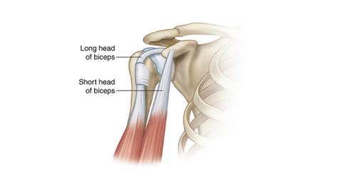 Long Head Of Biceps Tendinopathy