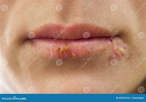 Lips With Herpes Before And After Treatment Stock Image