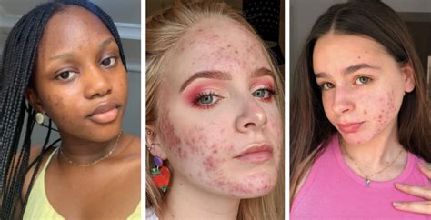 Acne Influencers Instagram Accounts That Show Off Real Skin Positivity