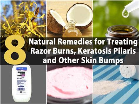 8 Natural Remedies For Treating Razor Burns Keratosis Pilaris And Other Skin Bumps Skin Bumps