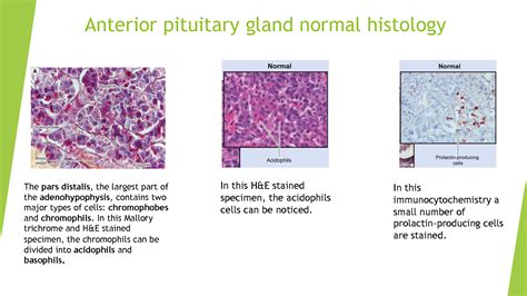 Solution Prolactinoma Anterior Pituitary Gland Normal Histology Ppt