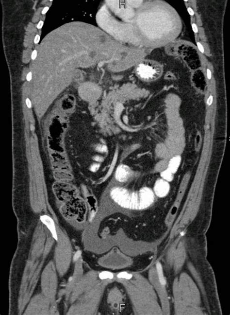 Sagittal Section Of Abdominal Ct Scan Showing Pericholecystic Fat
