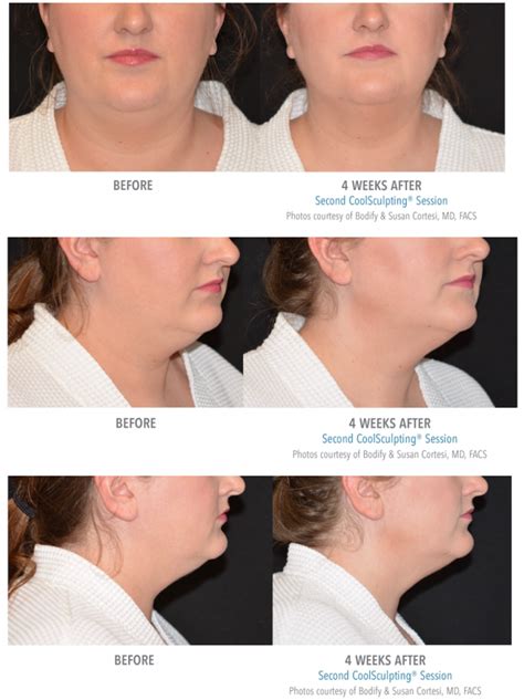 Coolsculpting Chin Before And After Pictures Picturemeta