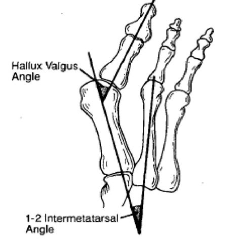 The Pathogenic Configuration Of Hallux Valgus Dorsal View Picture
