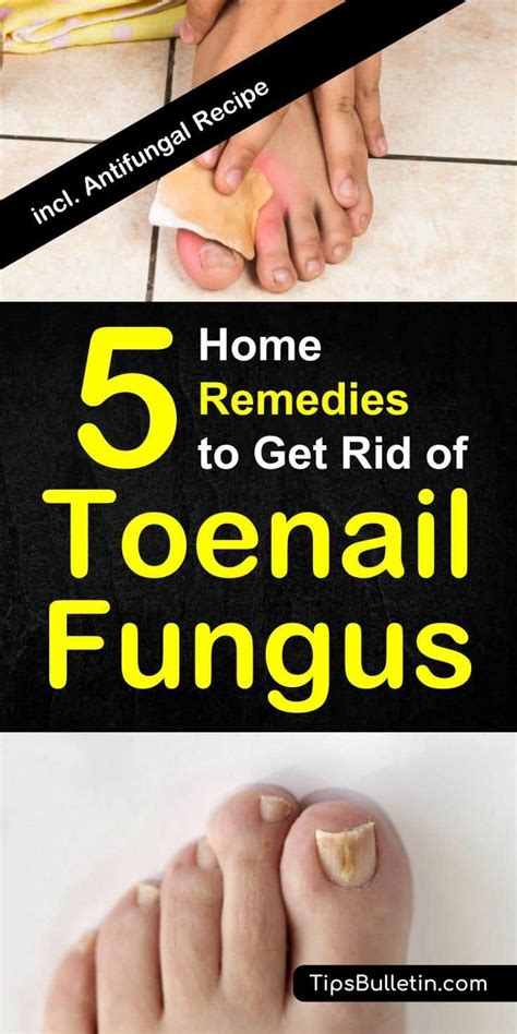 How To Get Rid Of Toenail Fungus 5 Home Remedies Toenail Fungus Toenail Fungus Remedies