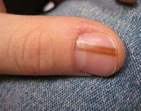 Hutchinson sign nail (dermatology) refers to pigmentation in the paronychial area suggesting aggressive subungual melanoma. Linee nere sulle unghie: prestiamo attenzione | Myskin ...