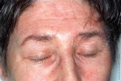 Seborrheic Eczema Face