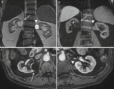 Resonance Imaging Of The Kidney Radiology Key