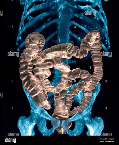 Normal Intestines Coloured 3d Computed Tomography Ct Scan Of The