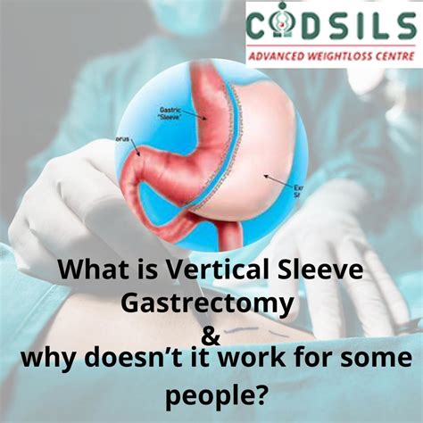 What Is Vertical Sleeve Gastrectomy And Why Doesnt It Work For Some People