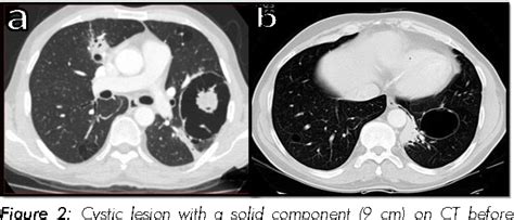 Figure 2 From Primary Pulmonary Extranodal Marginal Zone Lymphoma An