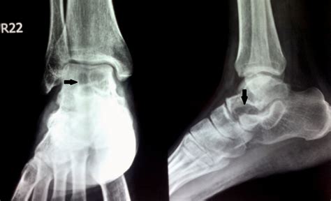 Radiographs Of Foot Showing Septate Lytic Lesion Black Arrows Of