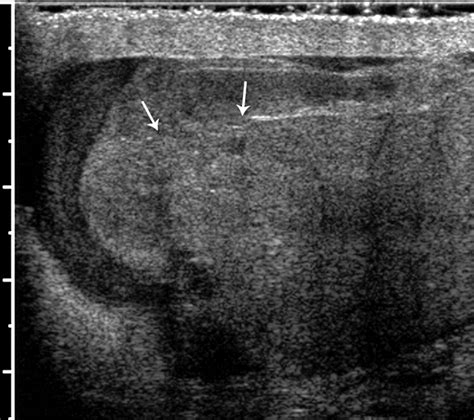 Us Of Acute Scrotal Trauma Optimal Technique Imaging Findings And