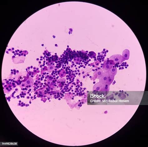 Fotomikrograf Mikroskop Urin Sitologi Urin Noda Pap Menunjukkan Sel Epitel Neutrofil Dan