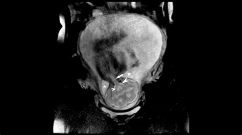 Cureus Utility Of Fetal Magnetic Resonance Imaging After Ultrasound