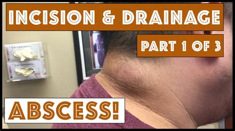 Incision And Drainage Of An Infected Cyst Part 1 Of 3 Youtube