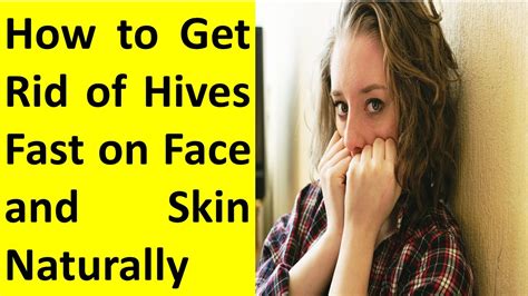 How To Get Rid Of Hives Fast On Face Naturally Youtube