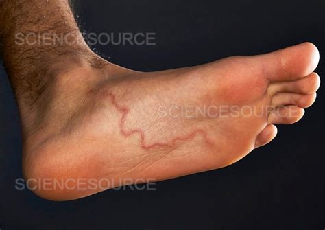 Photograph Hookworm Ascaris In Foot Science Source Images