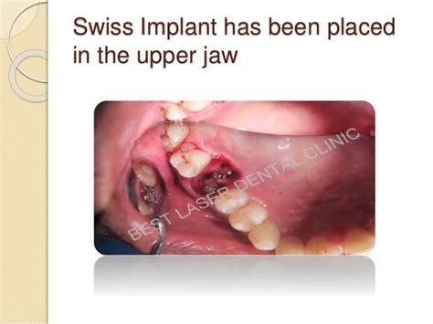 Upper Molar Extraction And Immediate Implant Placement